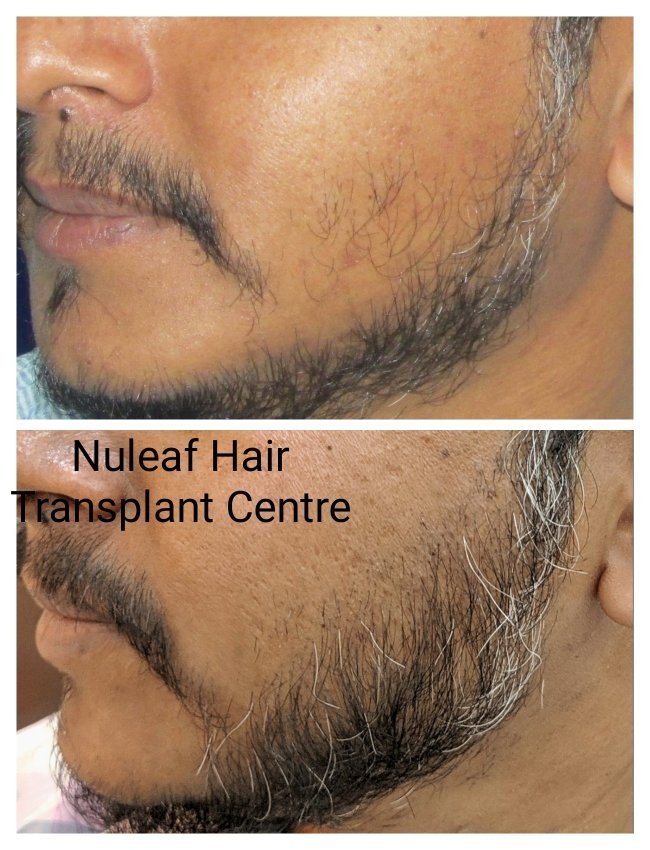 Beard Hair Transplant in Pune: Natural, Discount Season!