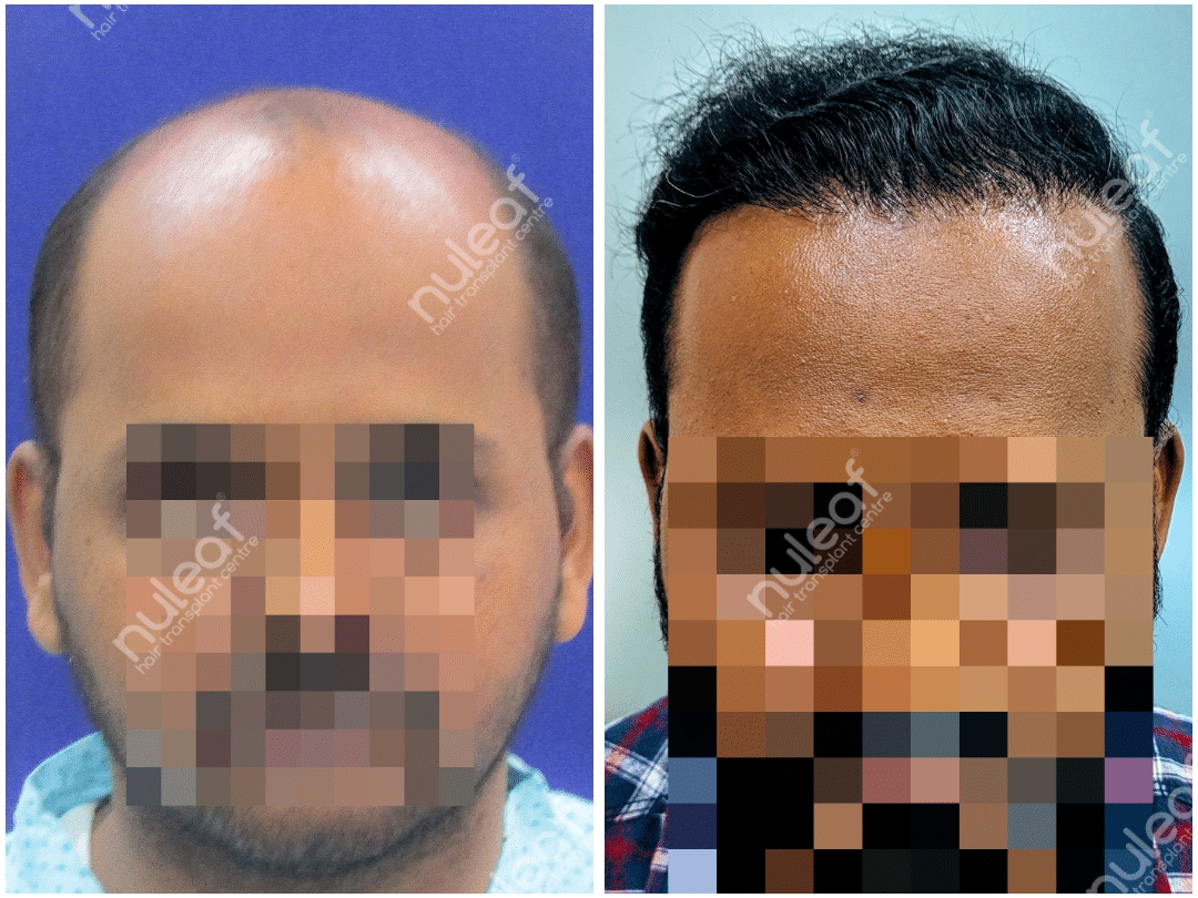 Hair Transplant in Pune:Excellent Results: Nuleaf Hair Transplant Centre