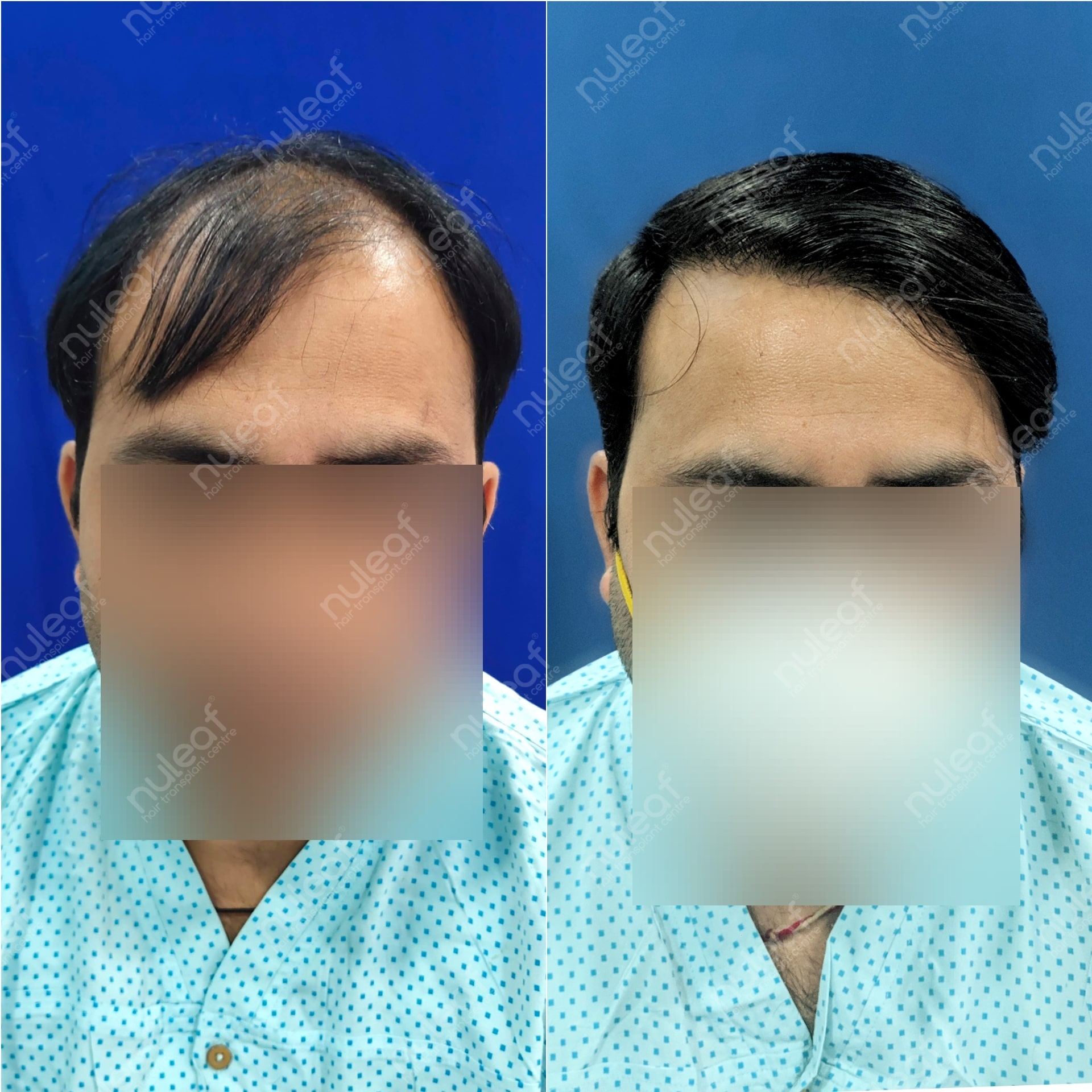 The real truth about low hairlines in hair transplant - Nuleaf Hair  Transplant Centre, Pune