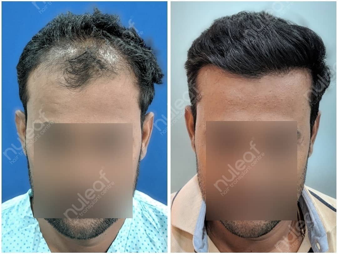 Hair Transplant in Pune from 2021's Top Rated Hair Transplant Centre in