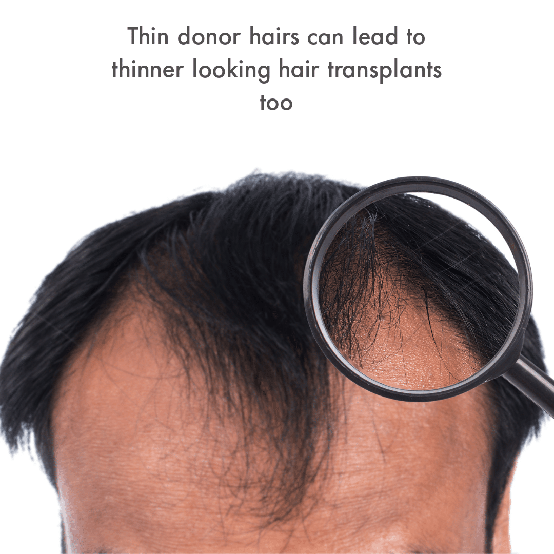 Thin Donor hair in the scalp: Will hair transplant work? - Nuleaf Hair  Transplant Centre, Pune