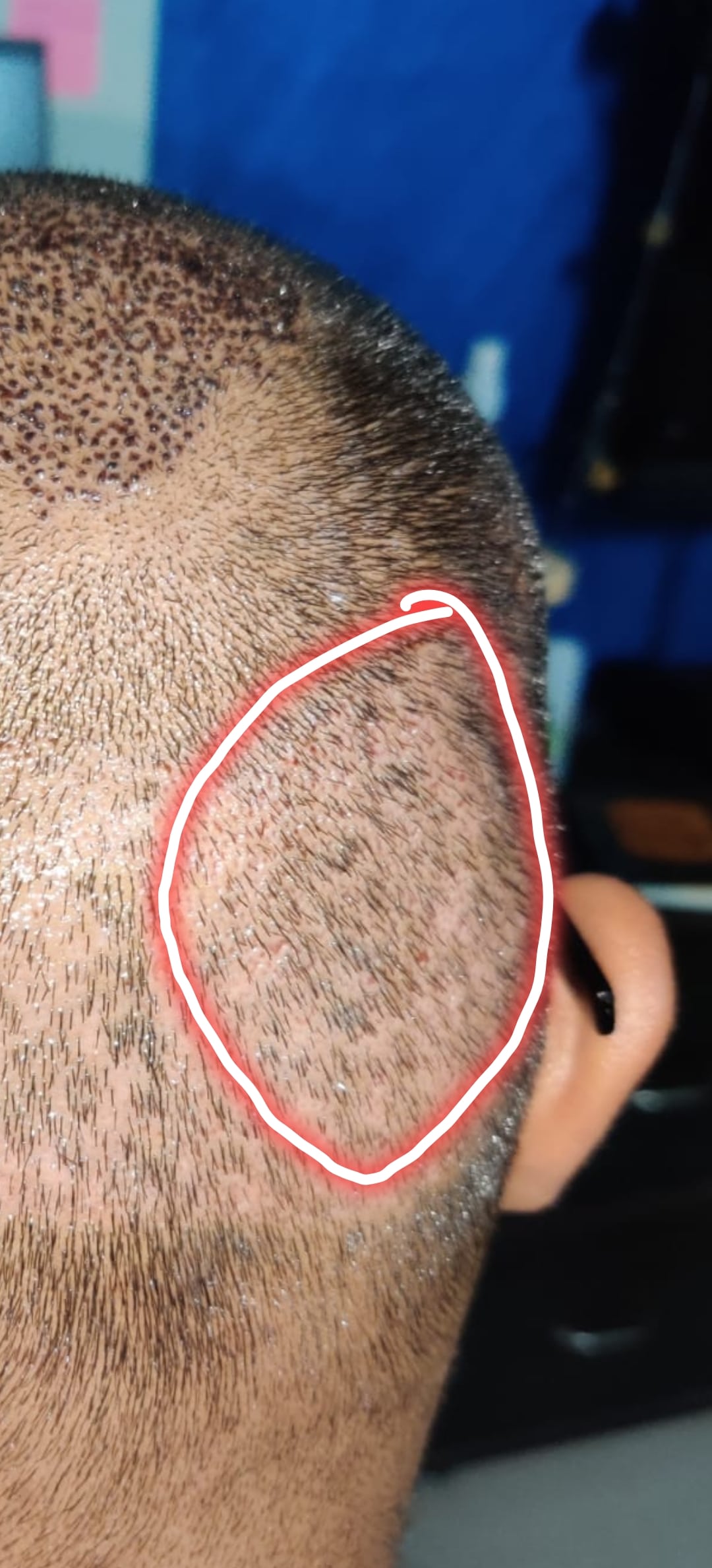 Can You Shave your head after a hair transplant? -